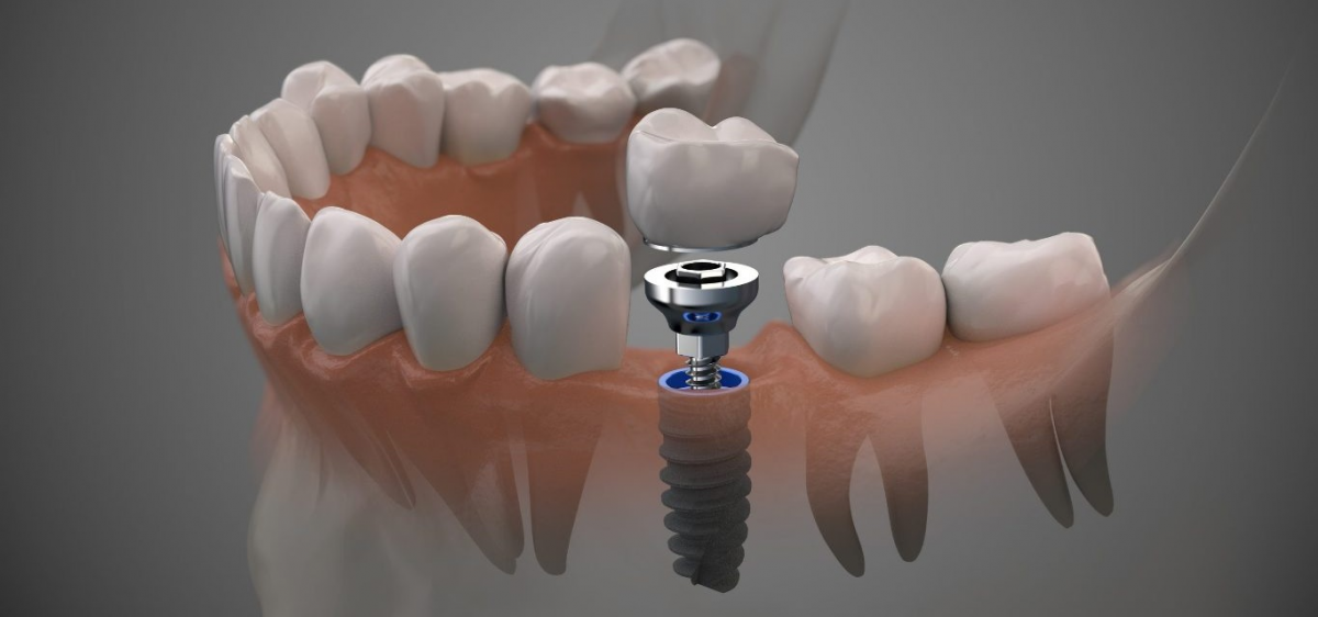 زراعة اسنان - دكتور اسنان محمد اكتورك - طرابزون - تركيا
