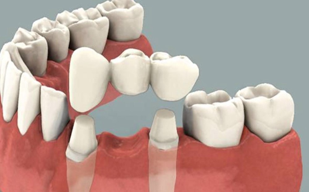 Porselen Diş - Diş Hekimi Muhammet Aktürk - Trabzon - Türkiye