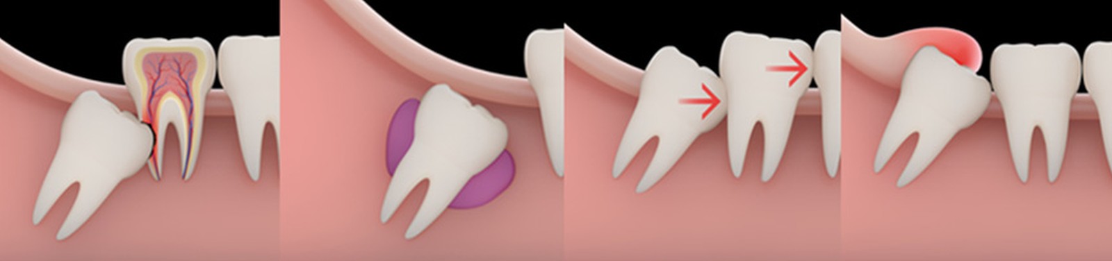 Wisdom Teeth Removal - Muhammet Akturk - Dentist - Trabzon - Turkey