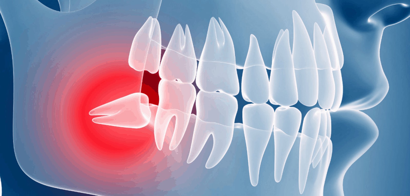 Wisdom Teeth Removal - Muhammet Akturk - Dentist - Trabzon - Turkey