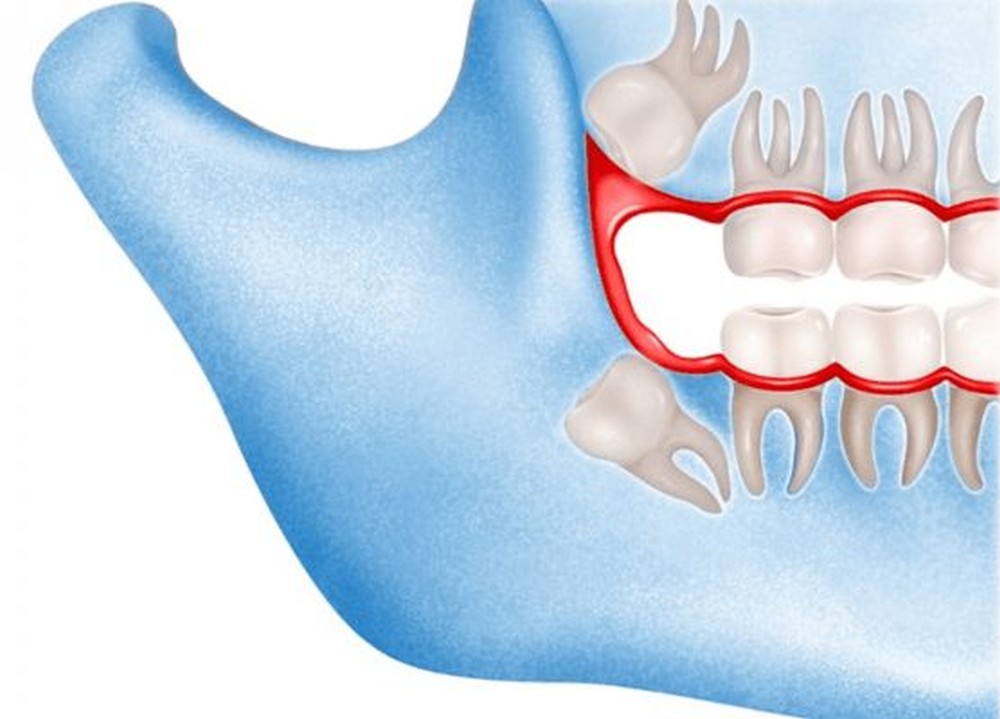 Wisdom Teeth Removal - Muhammet Akturk - Dentist - Trabzon - Turkey