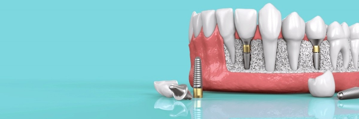 Dental İmplant -Diş Hekimi Muhammet Aktürk