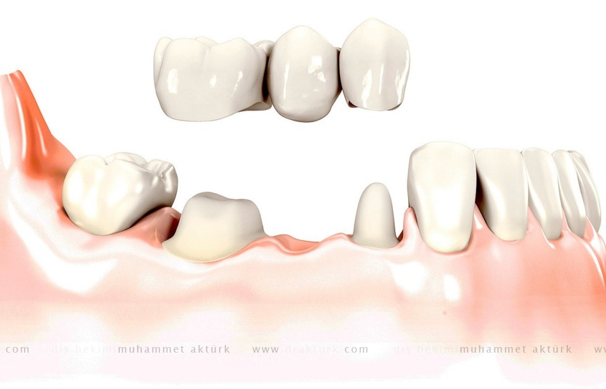 تيجان وجسور الأسنان - طبيب أسنان محمد أكتورك - طرابزون - تركيا