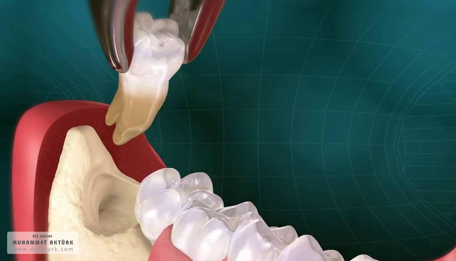 Diş Çekimi - Diş Hekimi Muhammet Aktürk - Trabzon - Türkiye