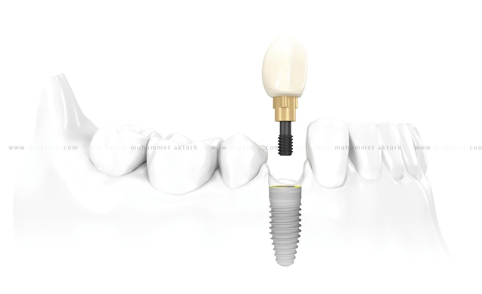 Dental İmplant - Diş Hekimi Muhammet Aktürk - Trabzon - Türkiye