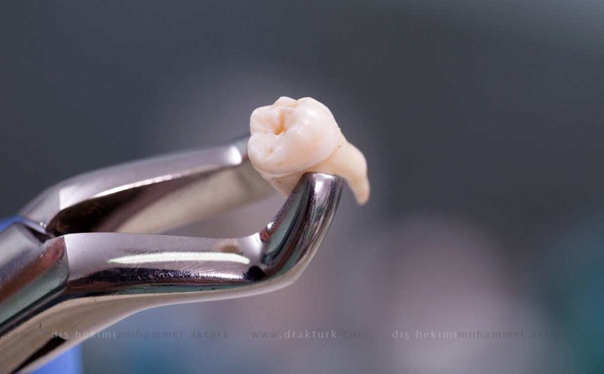 Diş Çekimi - Diş Hekimi Muhammet Aktürk - Trabzon - Türkiye