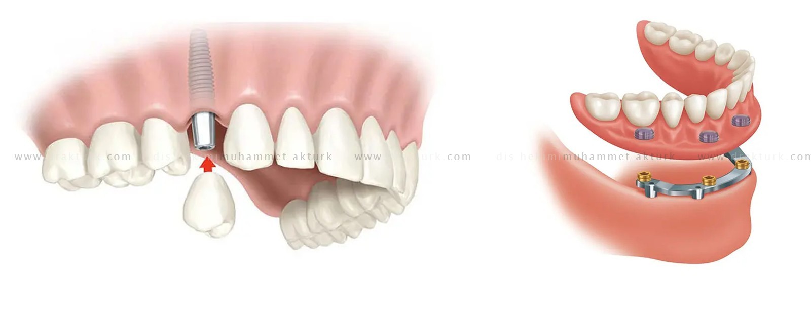 Dental Implant - Muhammet Akturk