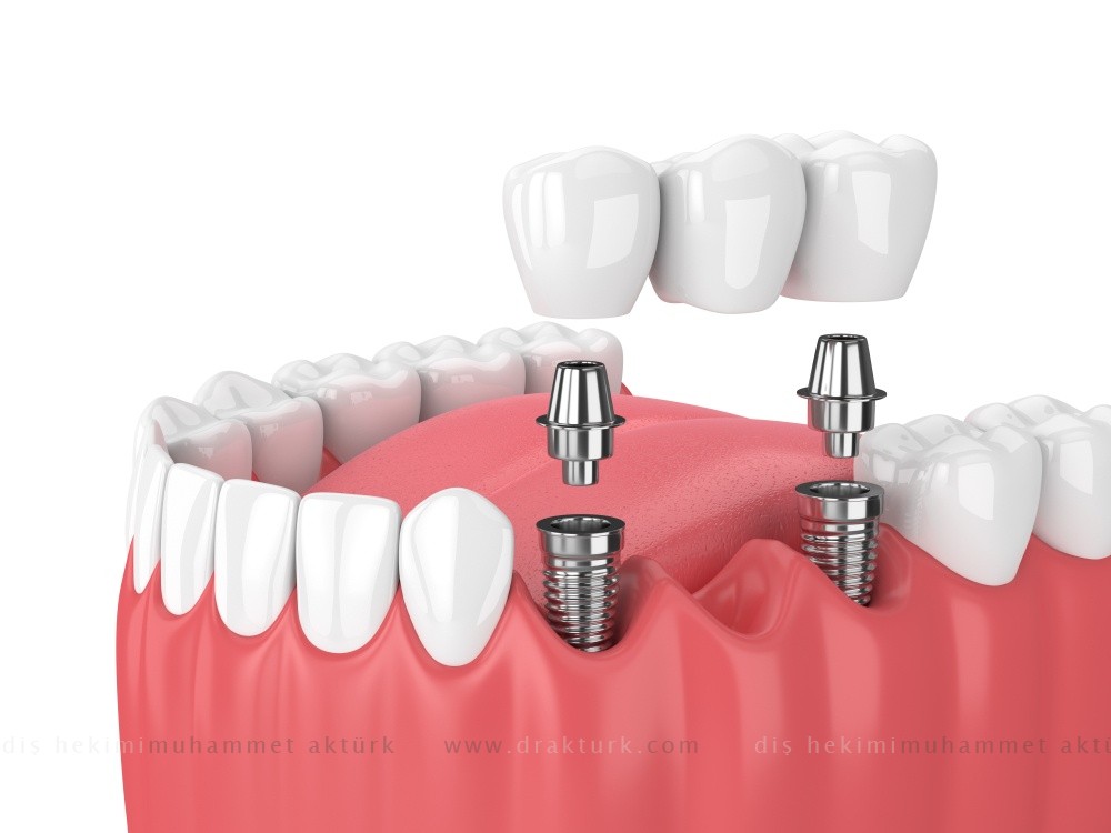 Dental Implant - Muhammet Akturk - Dentist - Trabzon - Turkey