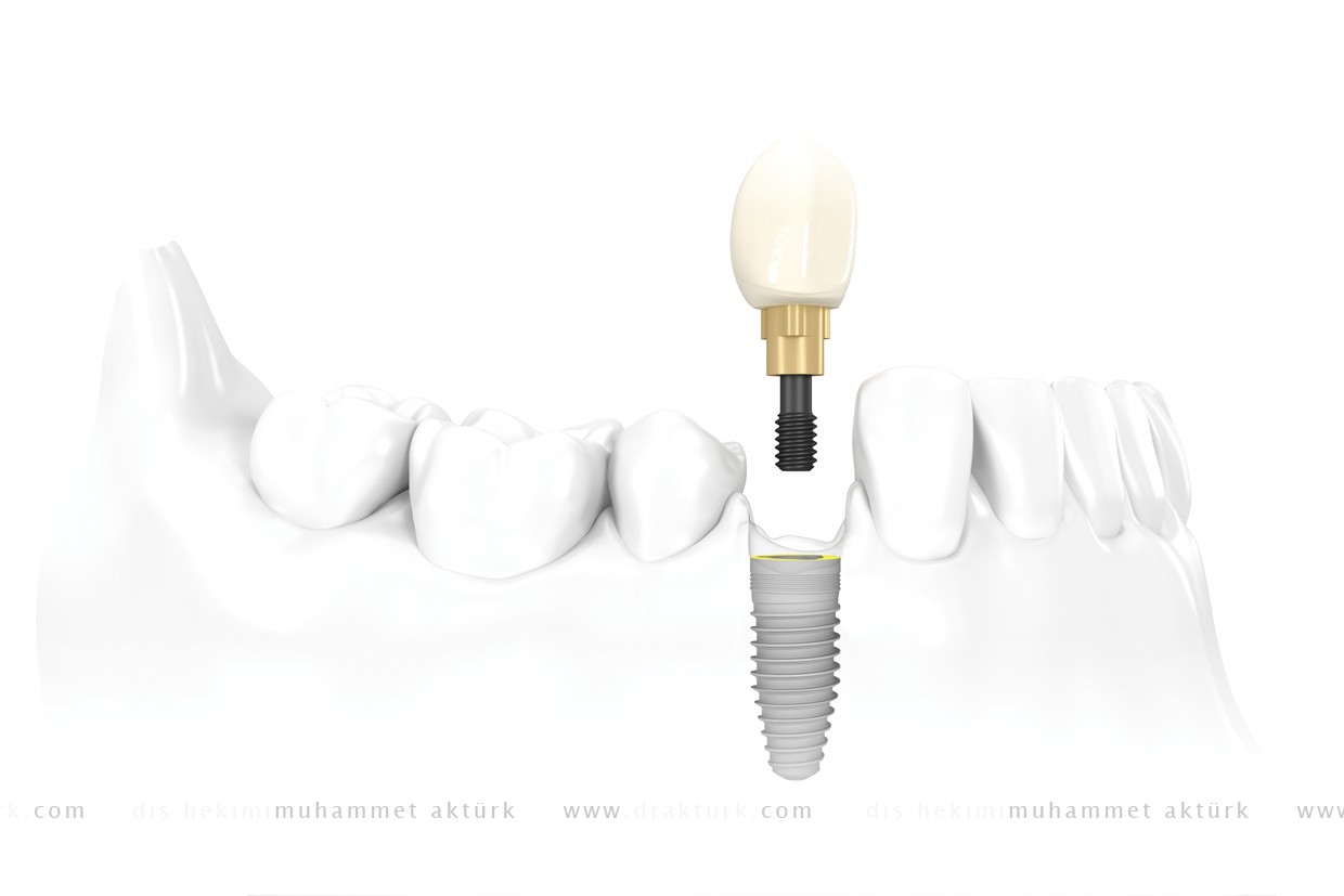 Dental Implant - Muhammet Akturk - Dentist - Trabzon - Turkey