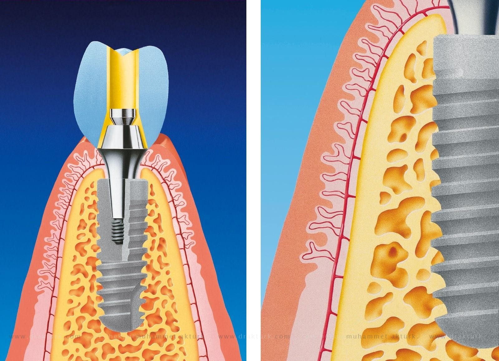 Dental Implant - Muhammet Akturk - Dentist - Trabzon - Turkey
