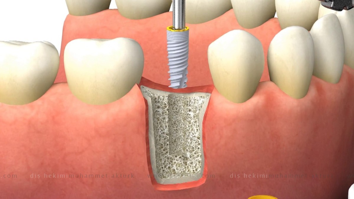 زراعة اسنان - دكتور اسنان محمد اكتورك - طرابزون - تركيا