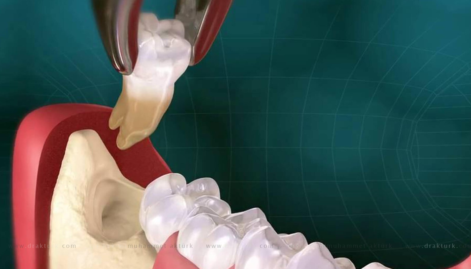 Tooth Extraction - Muhammet Akturk - Dentist - Trabzon - Turkey