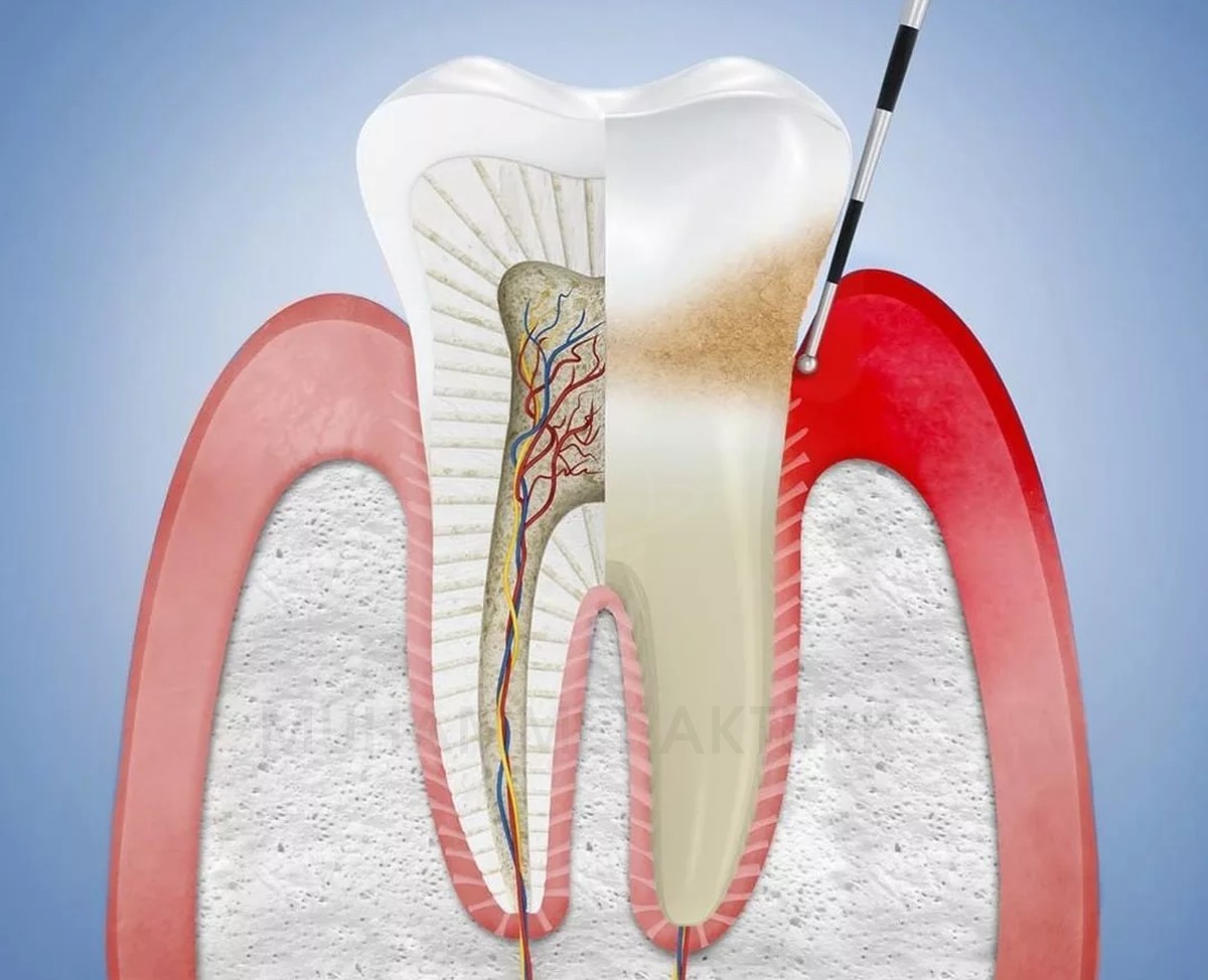 Gum Treatment - Muhammet Aktürk - Dentist - Trabzon - Turkey