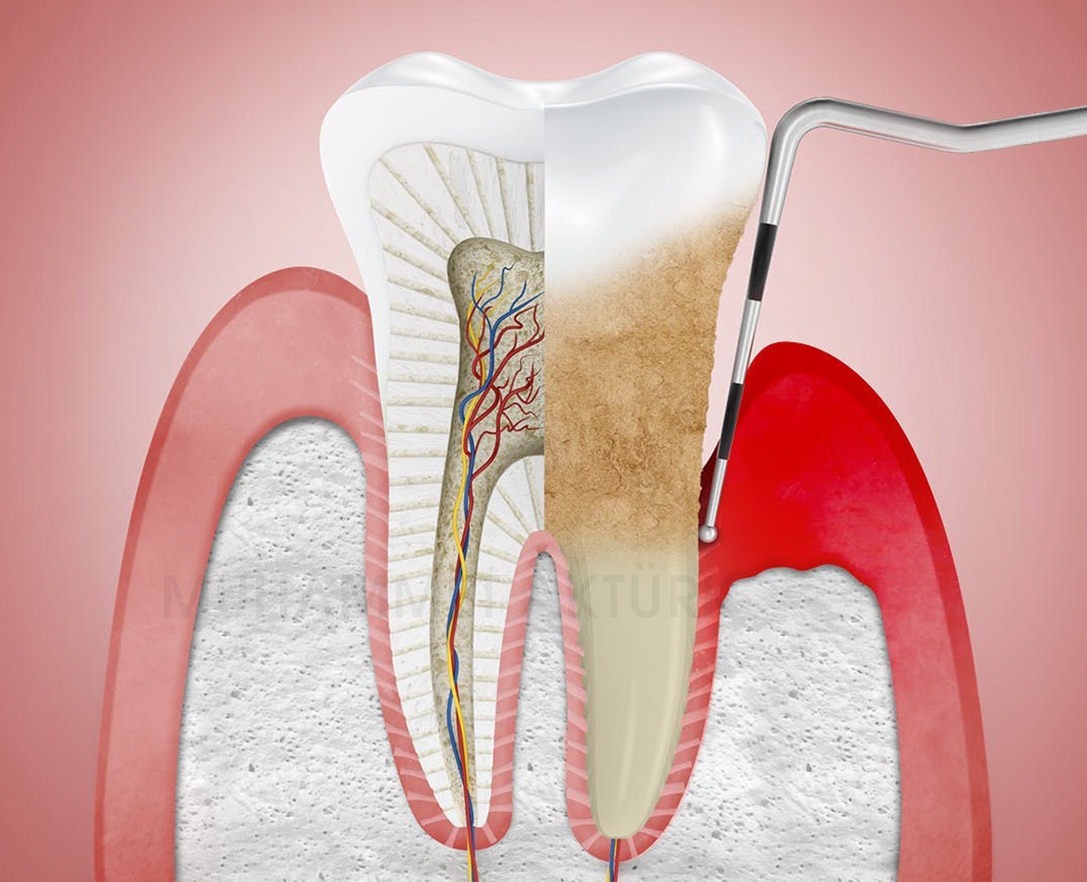 Gum Treatment - Muhammet Aktürk - Dentist - Trabzon - Turkey