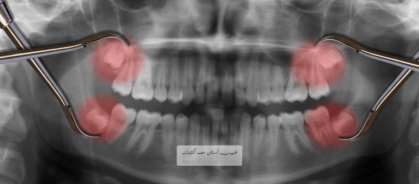 إزالة ضرس العقل - محمد أكتورك - طبيب أسنان - طرابزون - تركيا