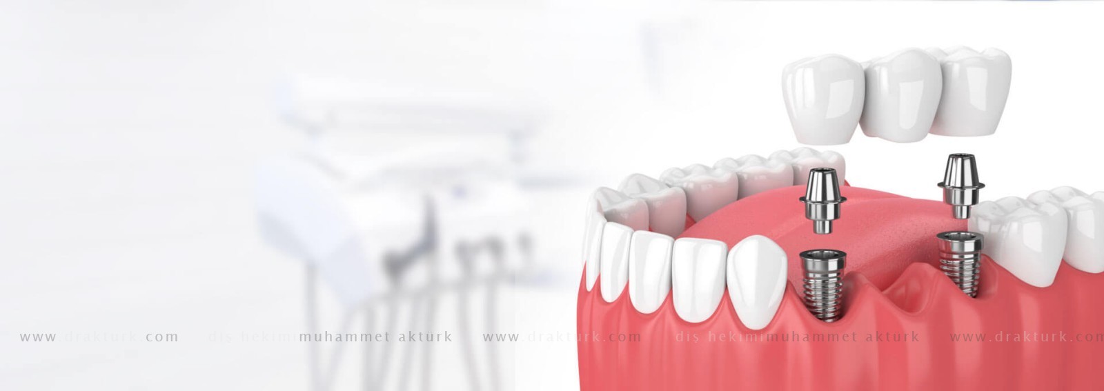 زراعة اسنان - دكتور اسنان محمد اكتورك - طرابزون - تركيا