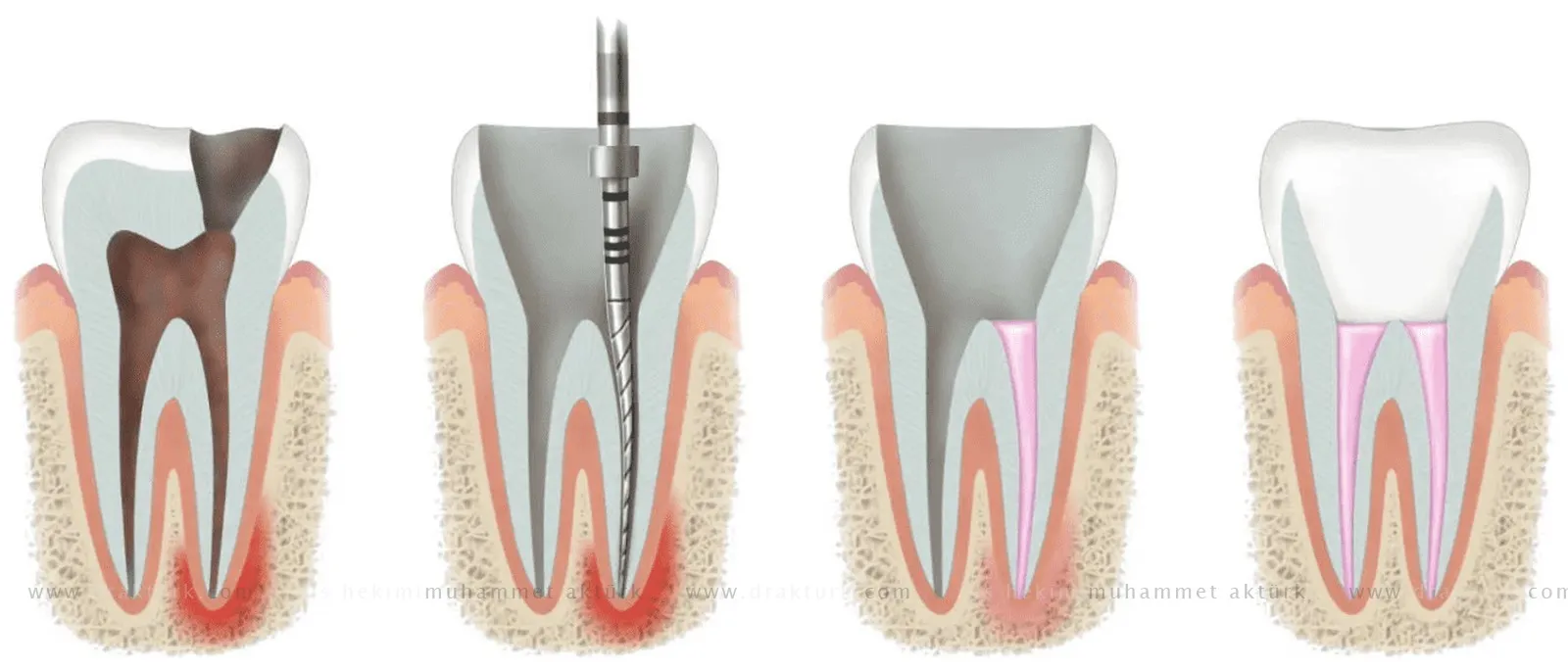 Root Canal Therapy - Dentist Muhammet Akturk - Trabzon - Turkey