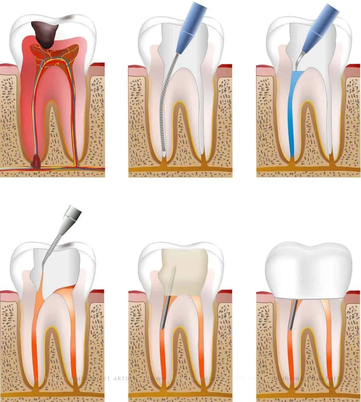Root Canal Therapy - Dentist Muhammet Akturk - Trabzon - Turkey