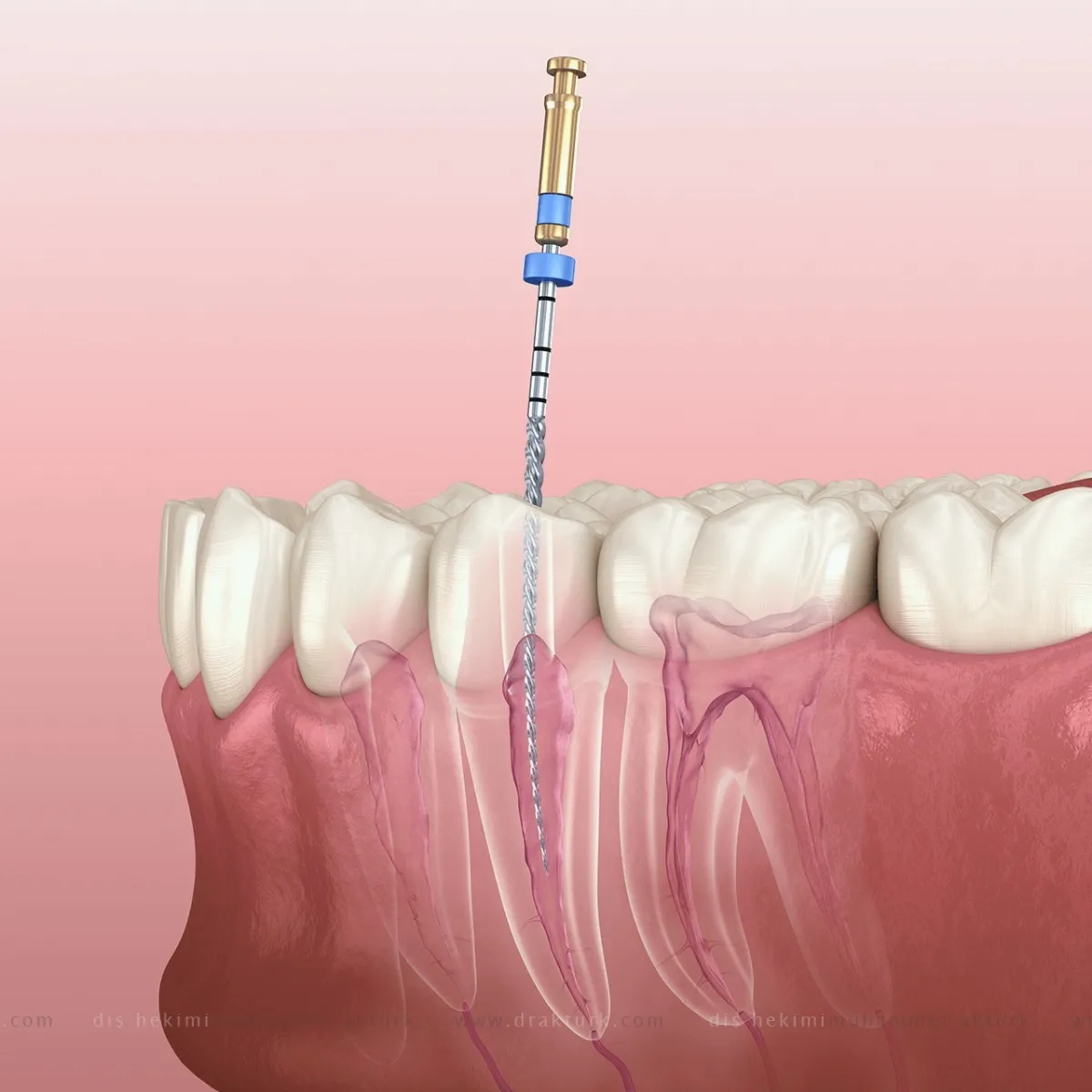 Root Canal Therapy - Dentist Muhammet Akturk - Trabzon - Turkey
