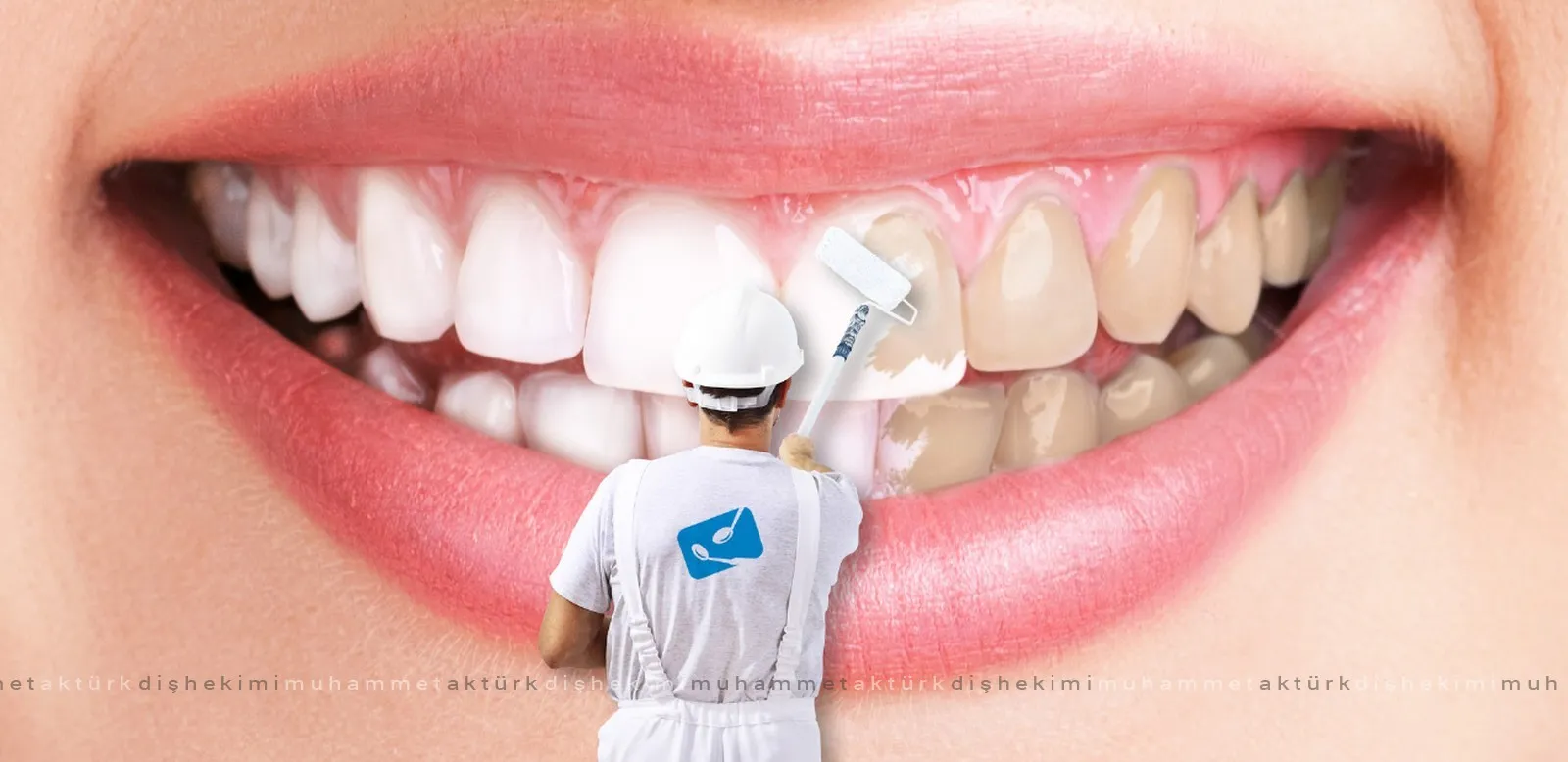 Teeth Whitening - Dentist Muhammet Aktürk - Trabzon - Turkey