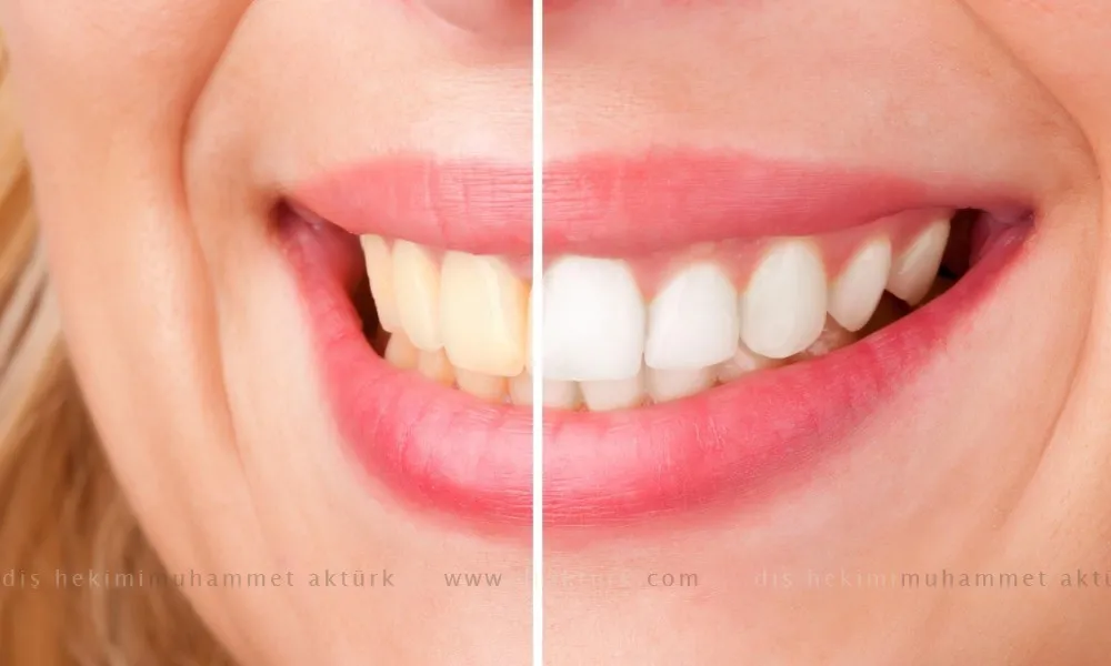 Teeth Whitening - Dentist Muhammet Akturk - Trabzon - Turkey