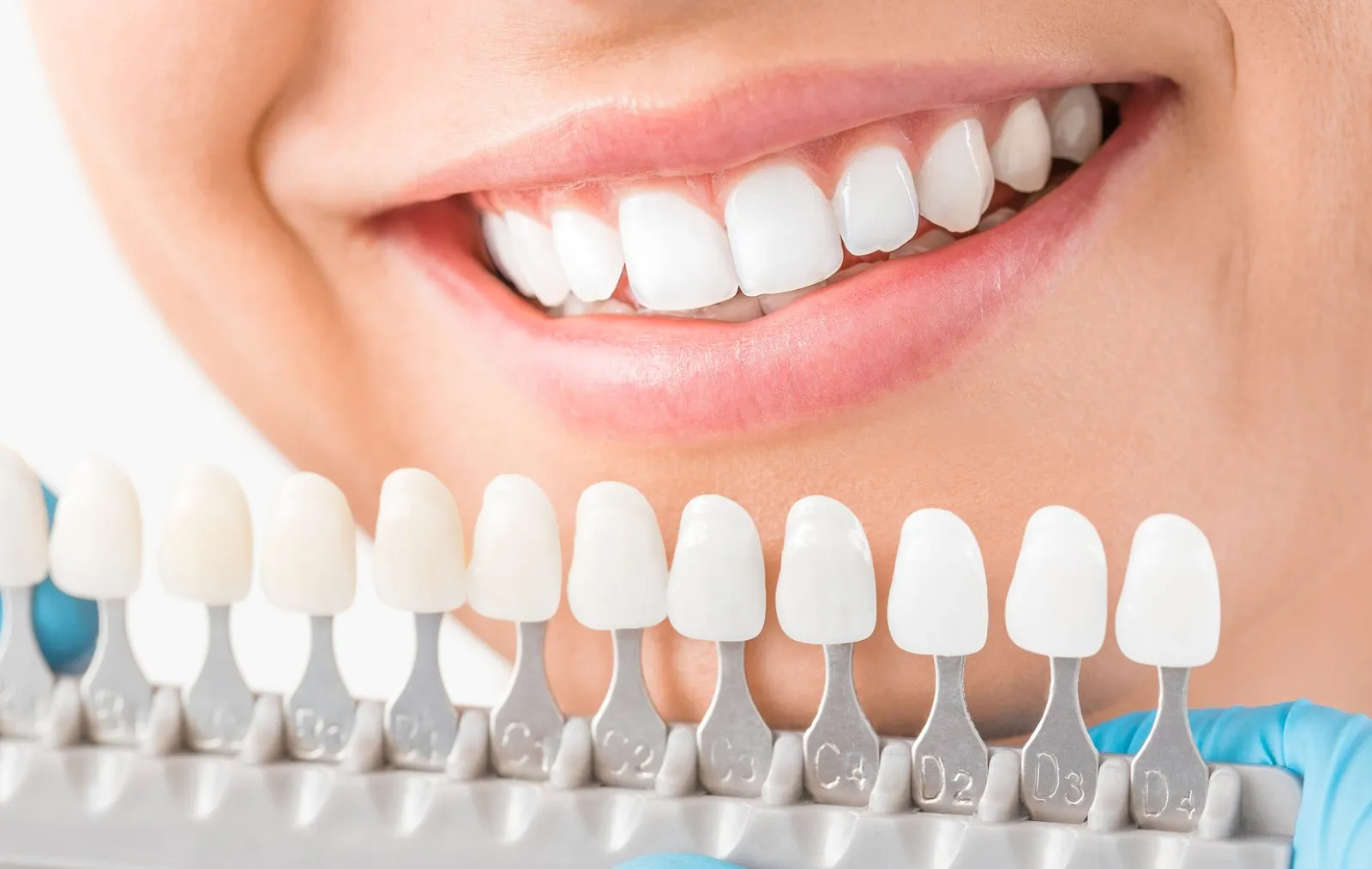Teeth Whitening - Dentist Muhammet Aktürk - Trabzon - Turkey