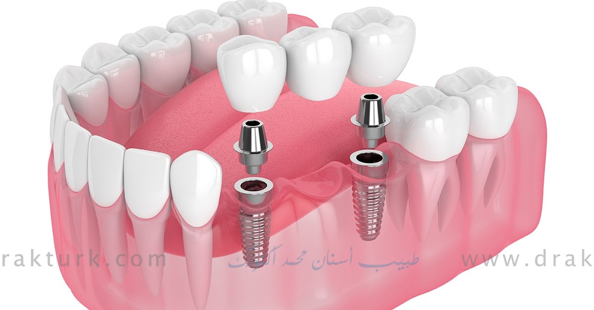 طبيب اسنان محمد اكتورك - طرابزون - تركيا